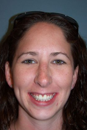 after orthodontics