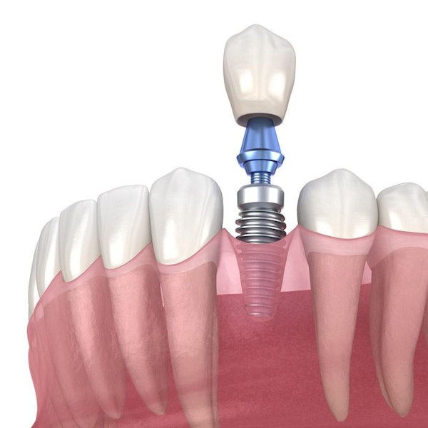 Dental Implant illustration
