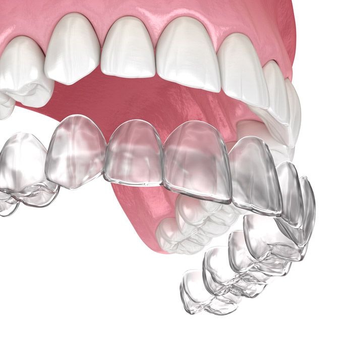 invisalign illustration