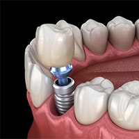 Implant-supported crown
