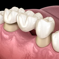 dental bridge