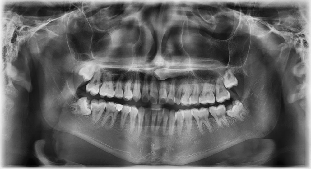 x-ray of wisdom teeth