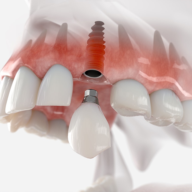 dental implant illustration