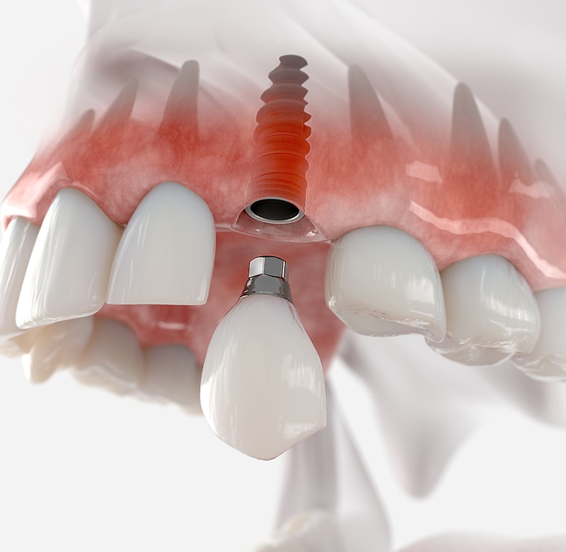 dental implant illustration