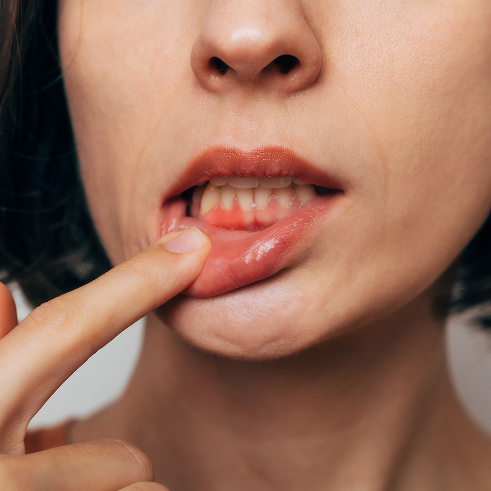 Close up of woman with gum disease
