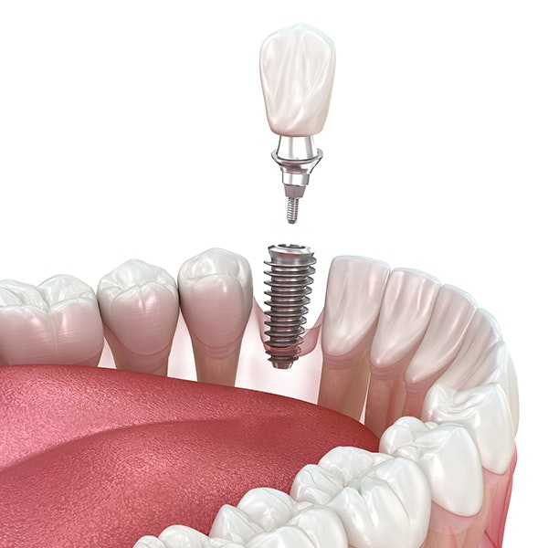 dental implant