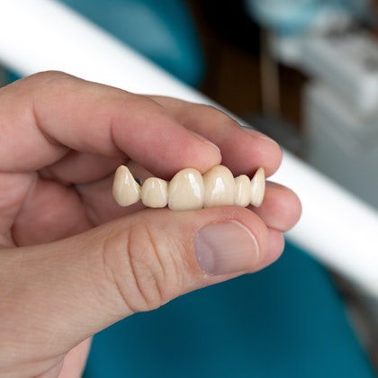 Dental bridge