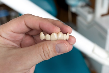 Dental bridge