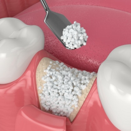 Bone grafting treatment