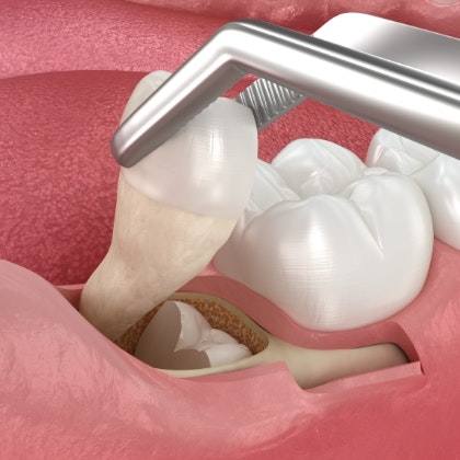 Tooth extraction procedure