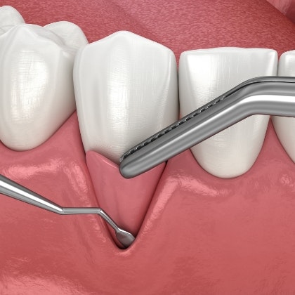 Gum grafting to address gum recession