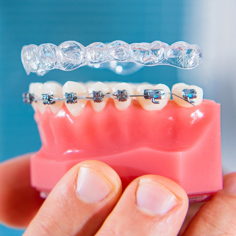 traditional and clear braces
