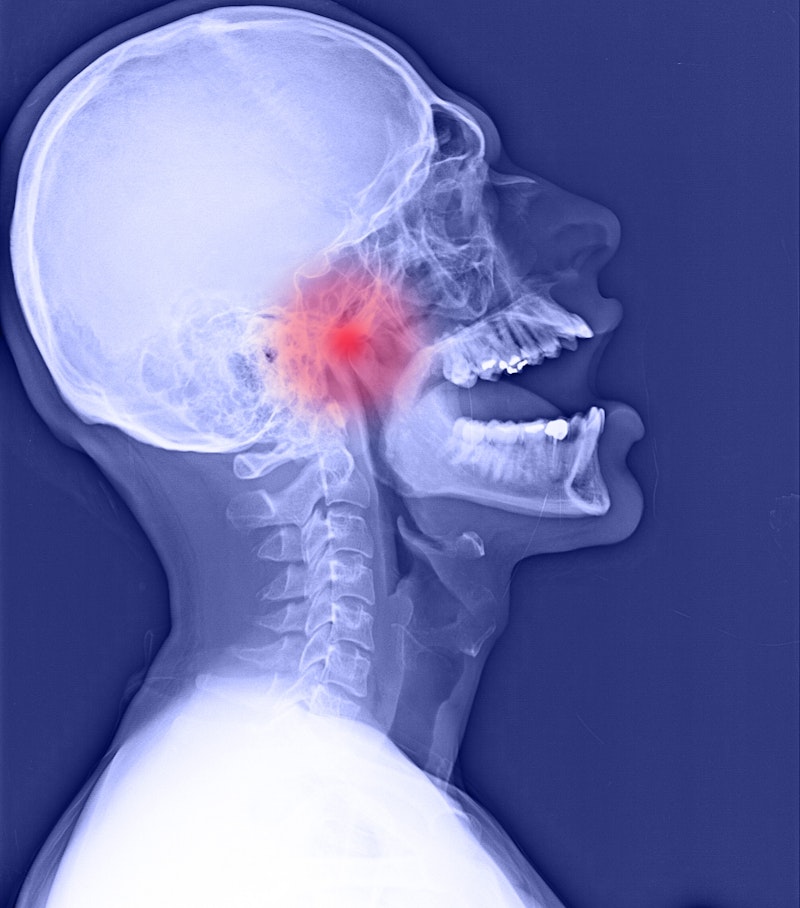 xray of jaw with TMJ highlighted