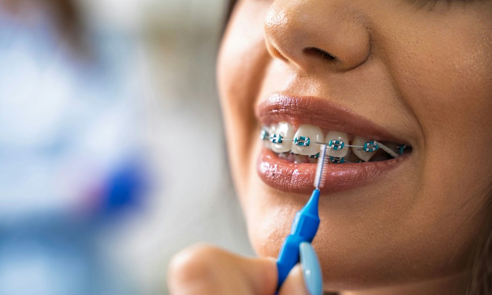 photo of woman with braces using a bracket brush