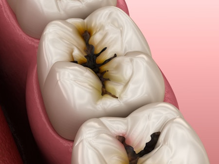 Illustration of cracked teeth