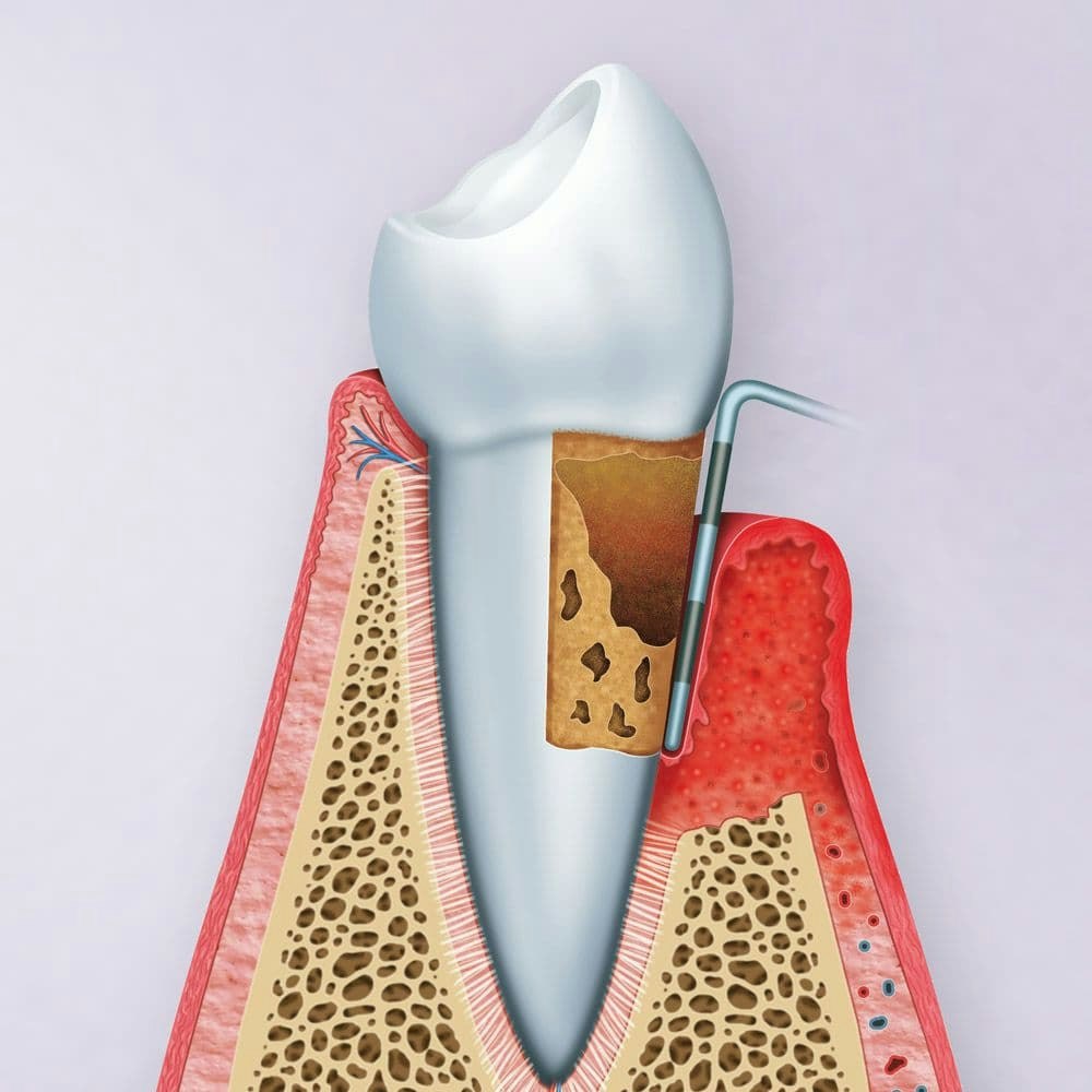 Diagram of deep cleaning