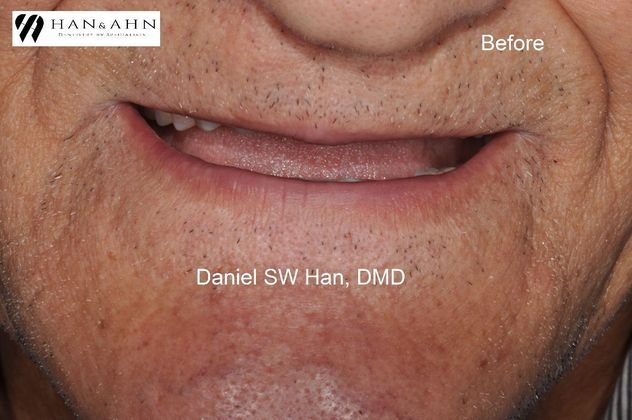 Before implants with Dr. Han