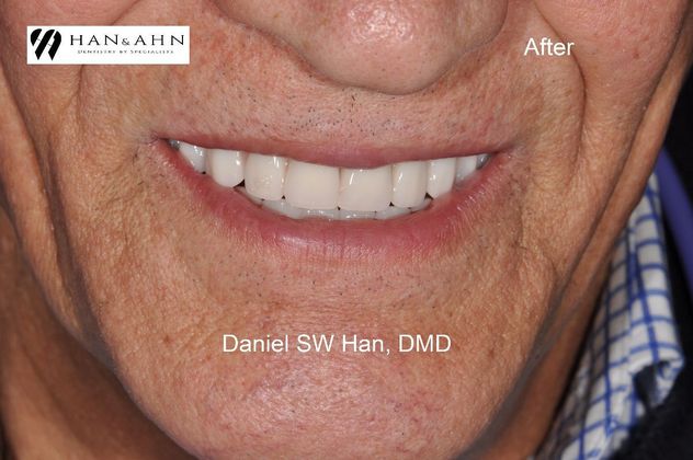 After implants with Dr. Han