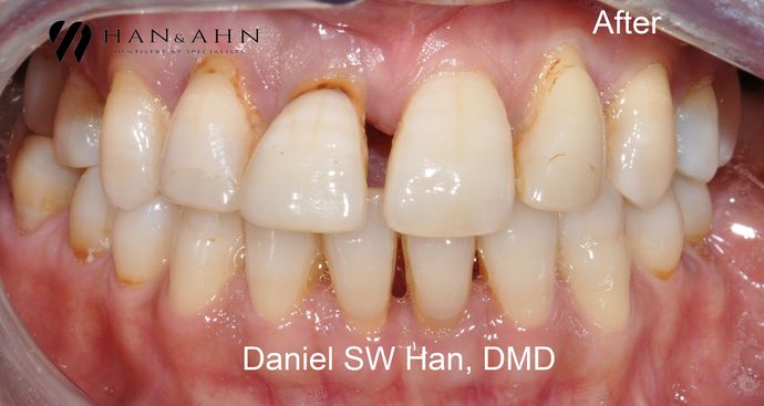 before restorative dentistry