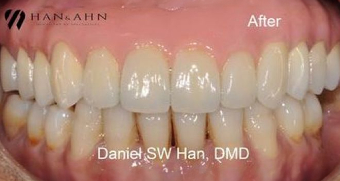 after restorative dentistry