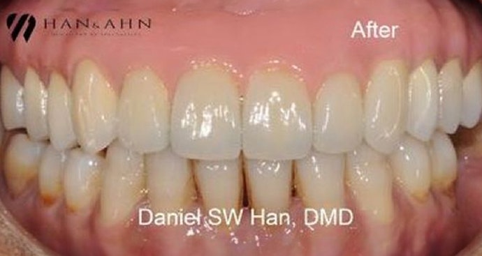 after restorative dentistry