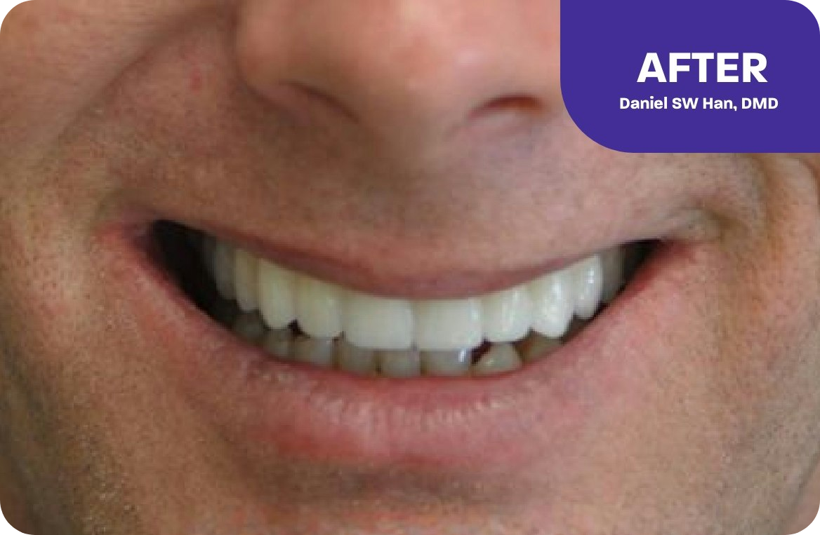 Our patient's new smile, showing a full arch of new teeth