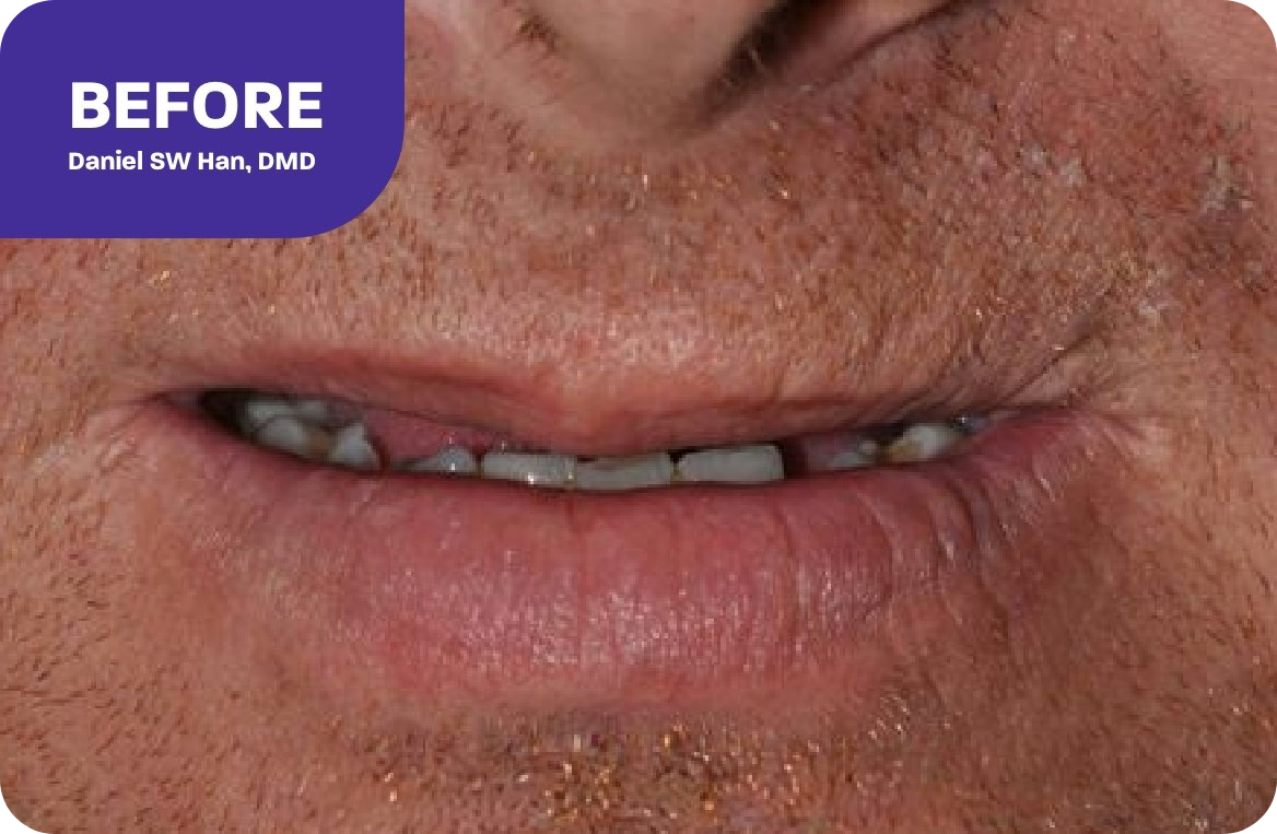 A dental implant patient's smile before treatment