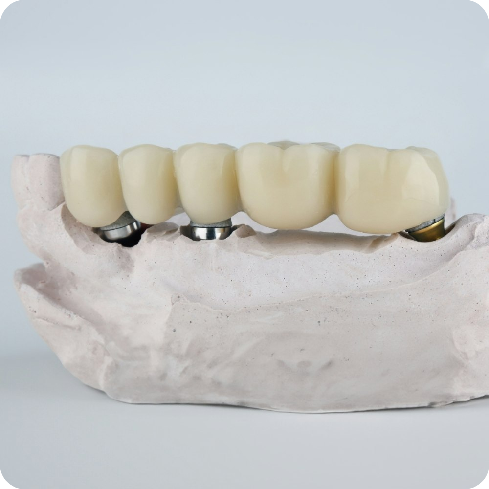 Implant-supported dental bridge on stone jaw model