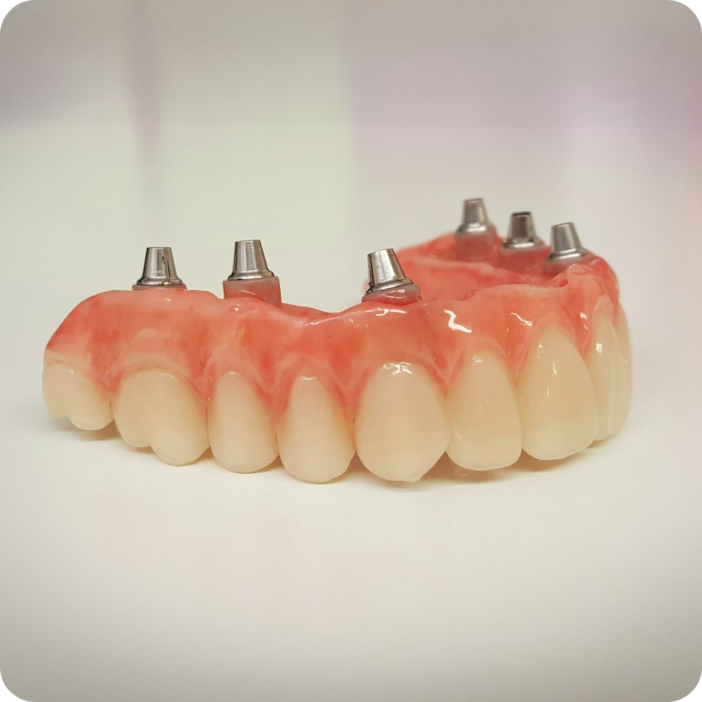 Upper full arch dental prosthesis with implant abutments