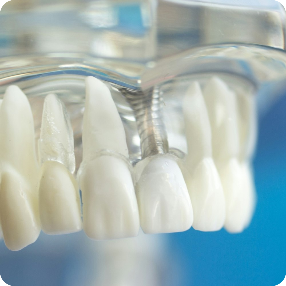 Transparent dental model showing single tooth implant placement