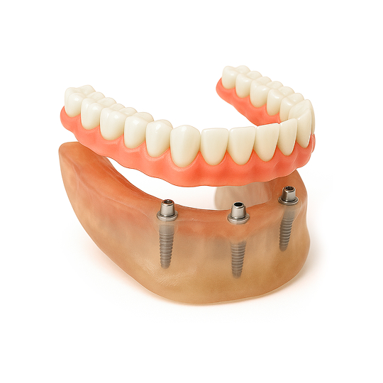 Fixed Hybrid Prosthesis