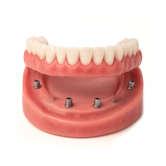 Implant supported dentures
