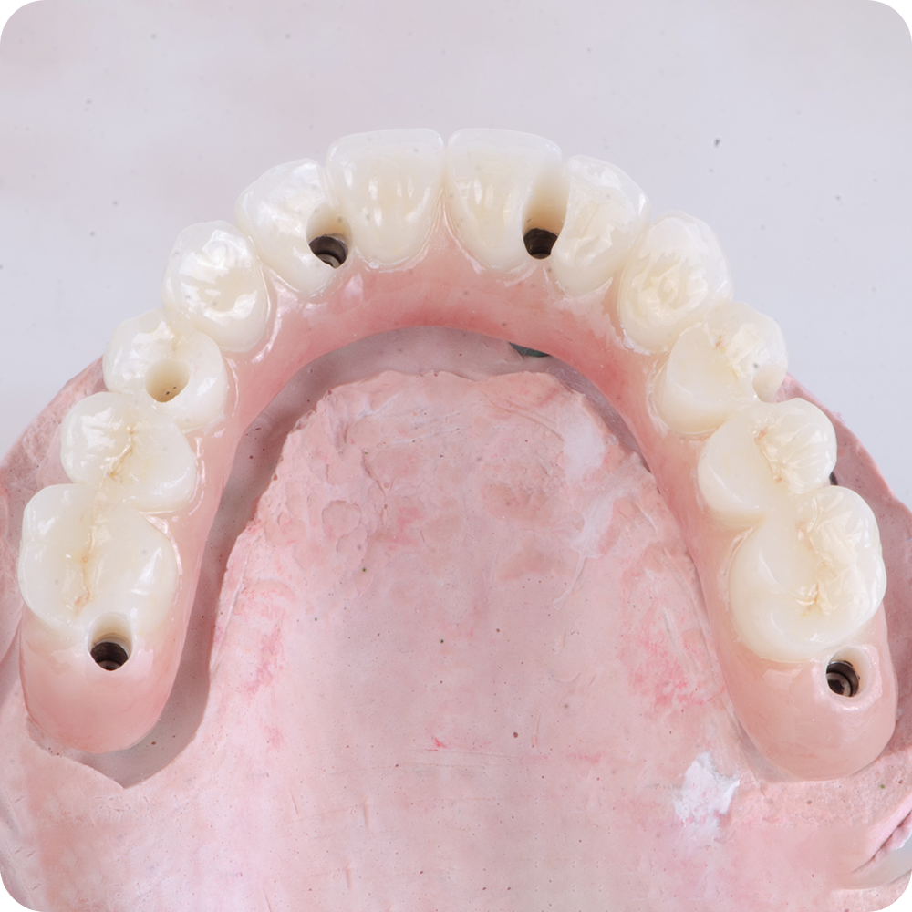 Upper full arch dental prosthesis with screw access holes on pink model base