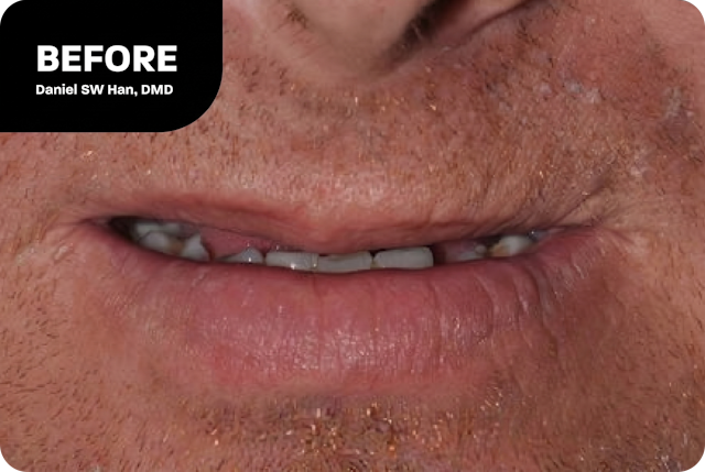 A dental implant patient's smile before treatment
