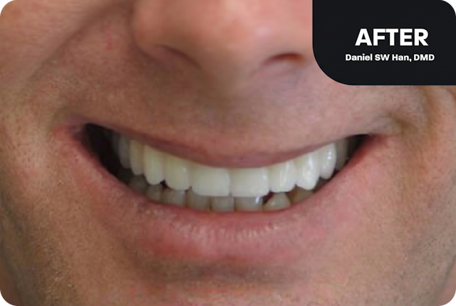 Our patient's new smile, showing a full arch of new teeth