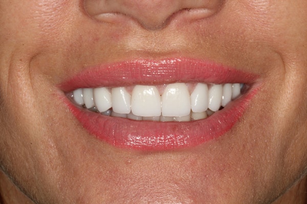 Porcelain Veneers for a renewed smile