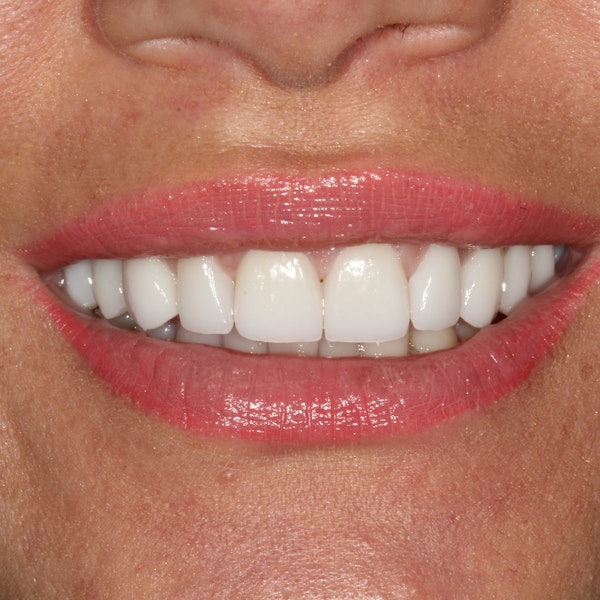 Porcelain Veneers for a renewed smile