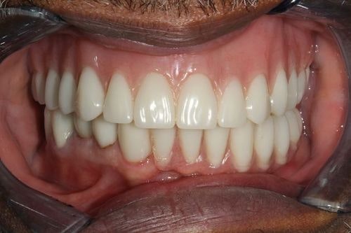 Patient after full mouth reconstruction