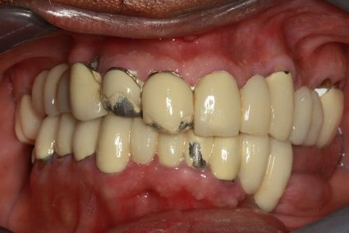 Patient before full mouth reconstruction
