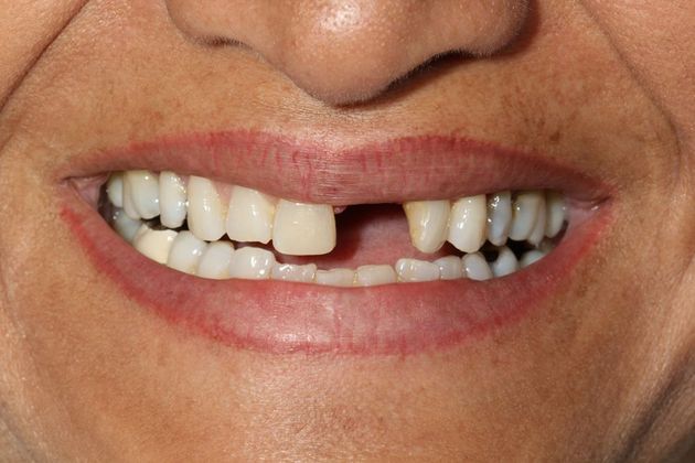 Before full mouth reconstruction