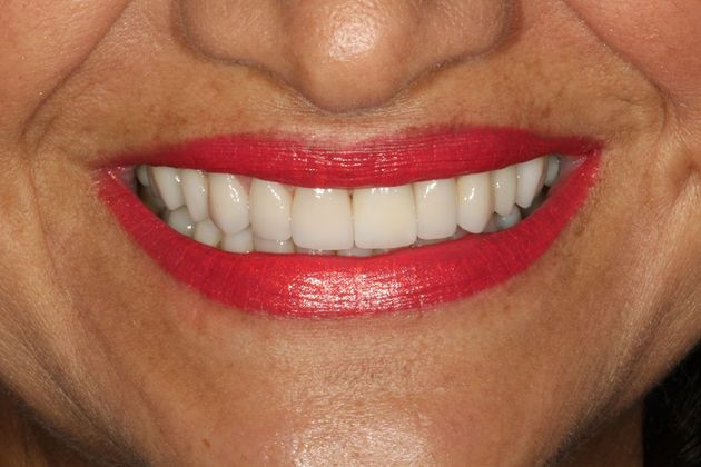 After full mouth reconstruction