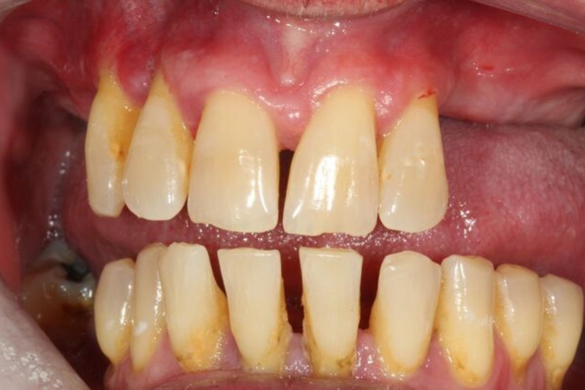 Dr. Anthony Ramirez's patient before implants