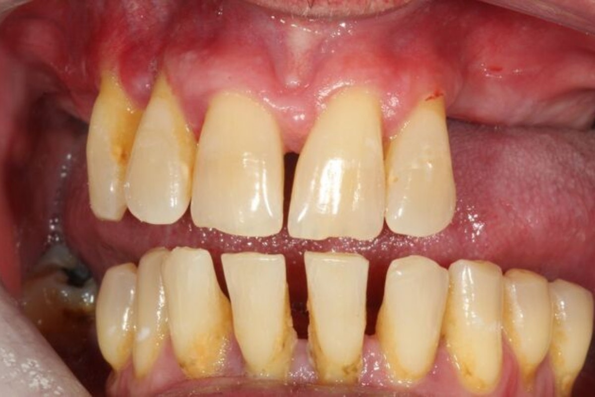 Dr. Anthony Ramirez's patient before implants