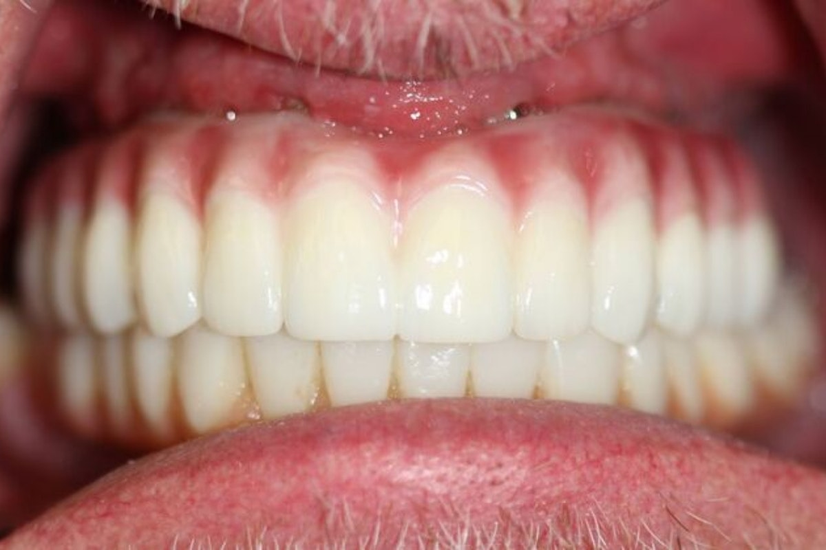 Dr. Anthony Ramirez's patient after implants