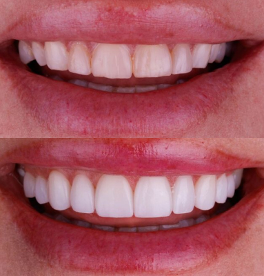 Dr. Nabors' patient with old restorations before and a beautiful smile after cosmetic dentistry