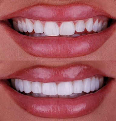 Dr. Nabors' patient with small teeth before and a beautiful smile after cosmetic dentistry