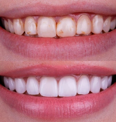 Dr. Nabors' patient with stained teeth before and a beautiful smile after cosmetic dentistry