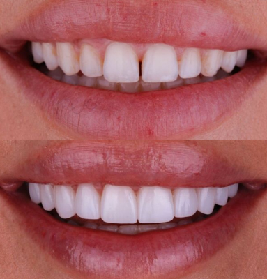 Dr. Nabors' patient with gapped teeth before and a beautiful smile after cosmetic dentistry
