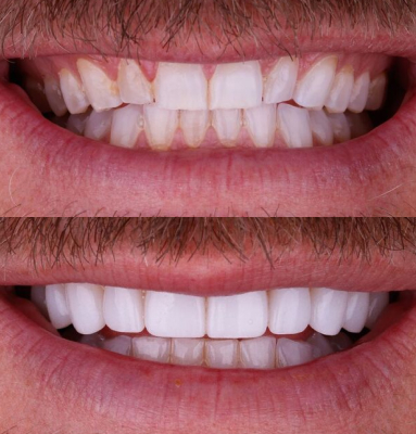 Dr. Nabors' patient with rotated teeth before and a beautiful smile after cosmetic dentistry