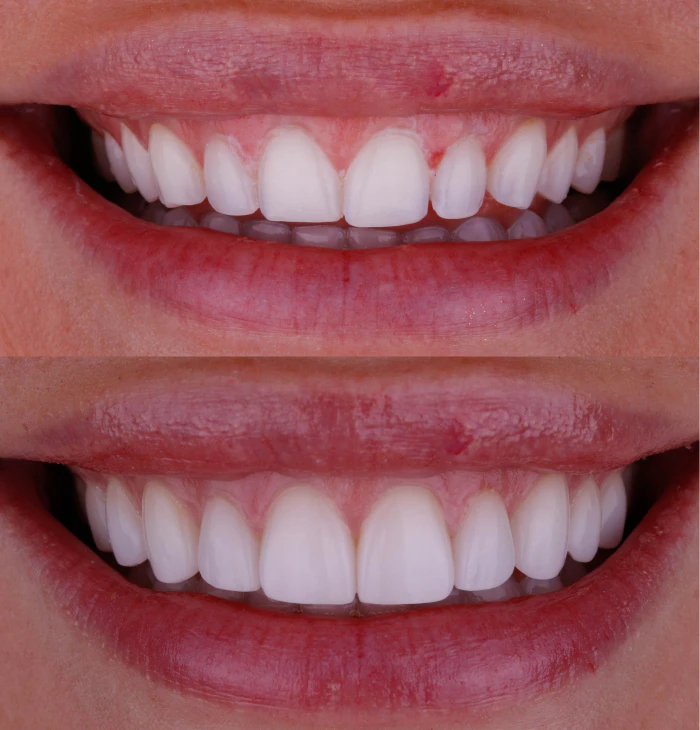 Emily before and after smile makeover